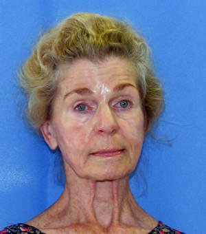 Suzanne K. Lammers, 75, of the 1600 block of Hepburn Drive in Lower Merion, was charged with causing an accident involving personal injury, a felony, and failure to stop and render assistance, a summary offense.