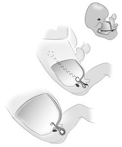 The evolutionary descent of the testes, from below the heart to a cooler place between the legs. The move, however, created a risk of hernias.