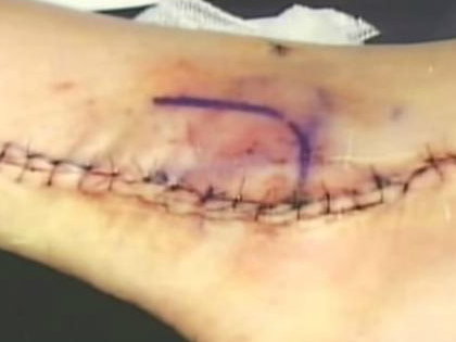 Curt Schilling Shares Photo of His Stitched-Up Ankle from 2004