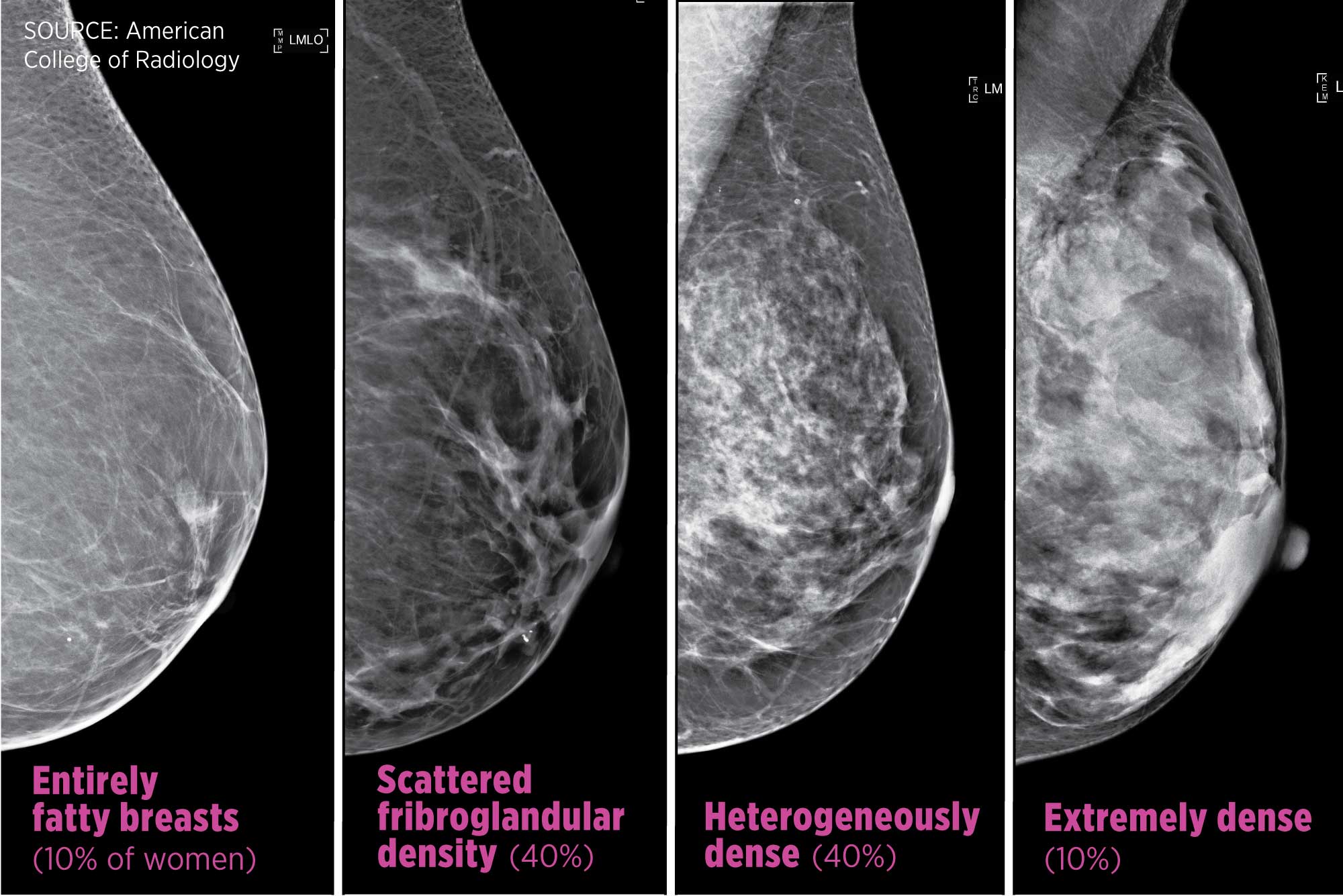 Imaging breast mammogram