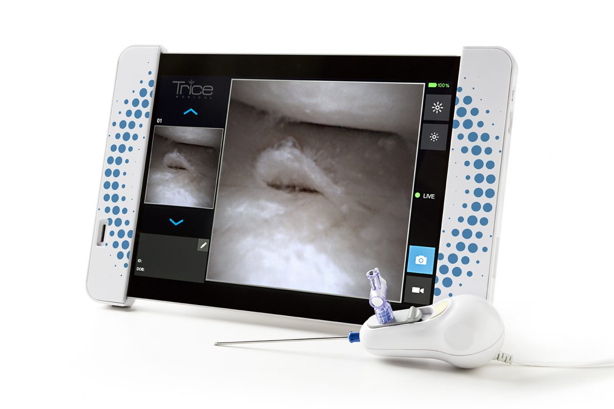 Trice Medical&acute;s Mi-Eye enables doctors to diagnose a sports-related injury in the office, without an MRI. It consists of a hypodermic needle with a small camera tethered to a Microsoft surface tablet that shows high-definition pictures. In this case, a meniscus tear. 