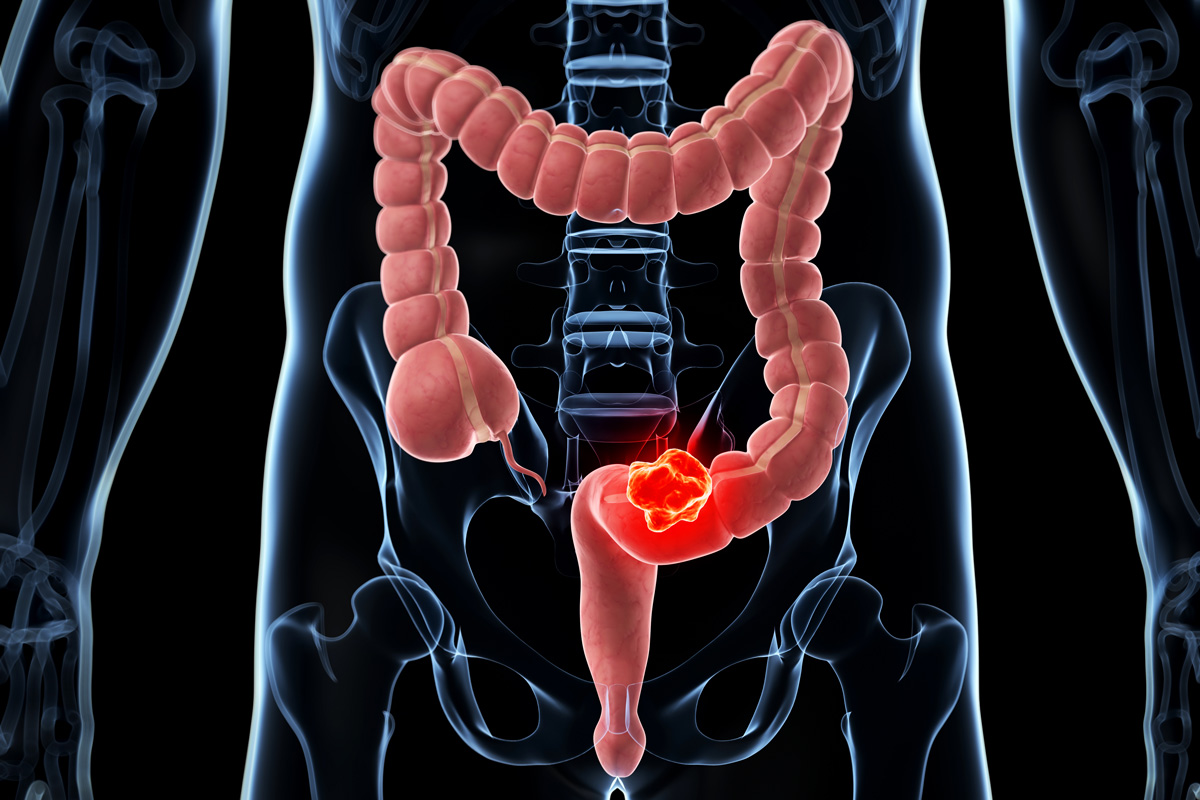 Colorectal Cancer Rates Rising Sharply Among Gen X And Millennials