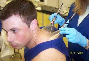 Airborne chemicals from volunteer Neil Gallagher´s back are collected in funnels for research on healthy skin. Scientists at the Monell center later compared the findings to samples from tumors to create an "odor profile" of basal cell carcinoma.
