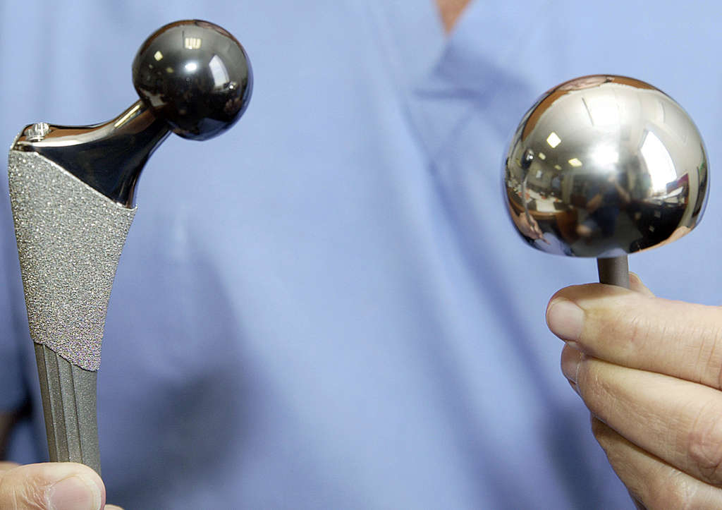 Titanium Joint Replacement